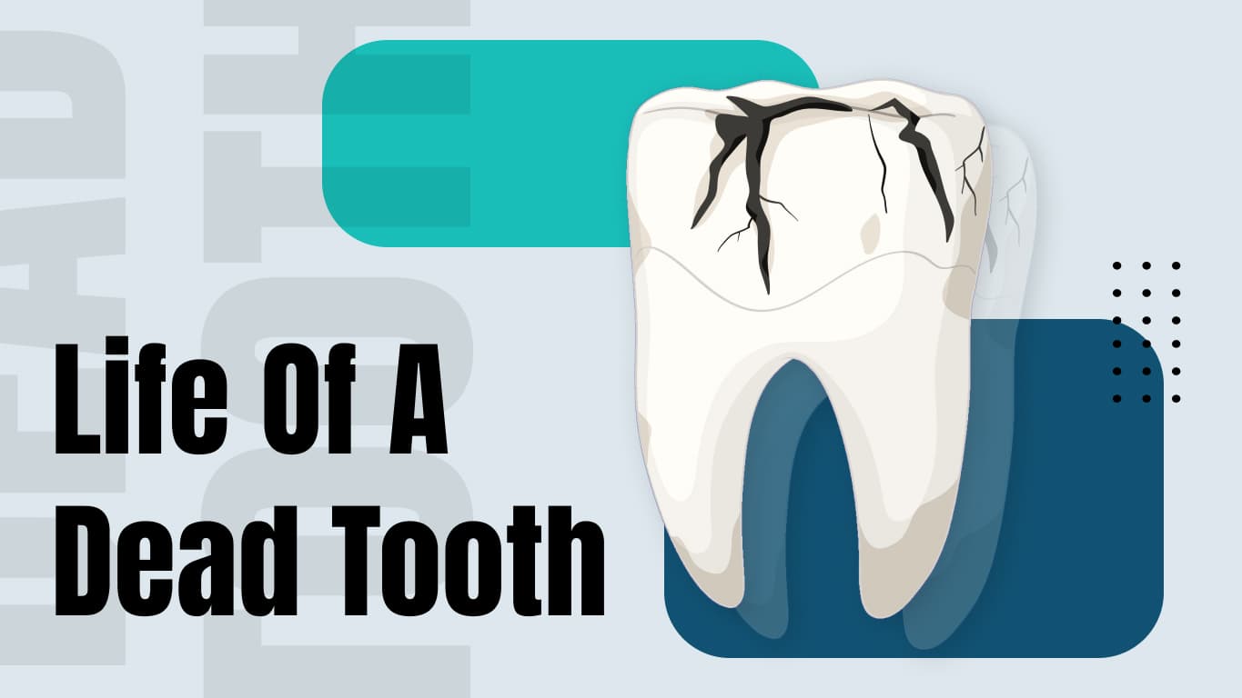 Life of a Dead Tooth: Causes, Symptoms & Treatment Options