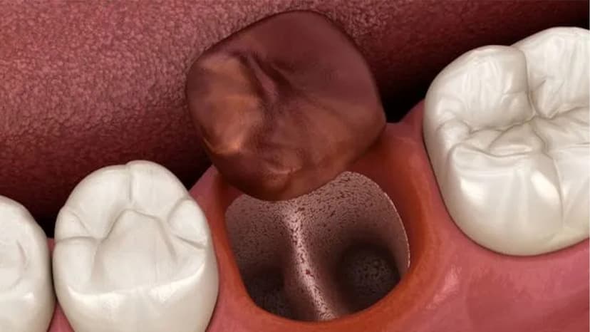 Empty Socket Top Strategies to Prevent Dry Socket After Dental Surgery
