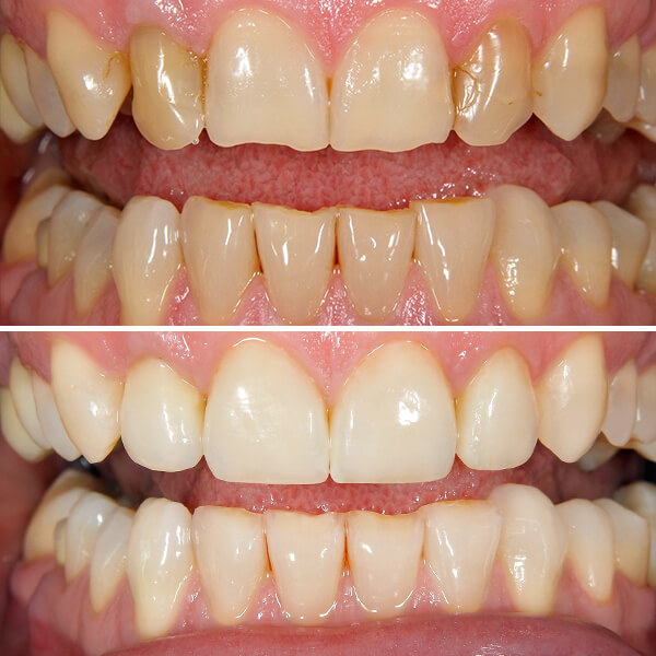 Invisalign