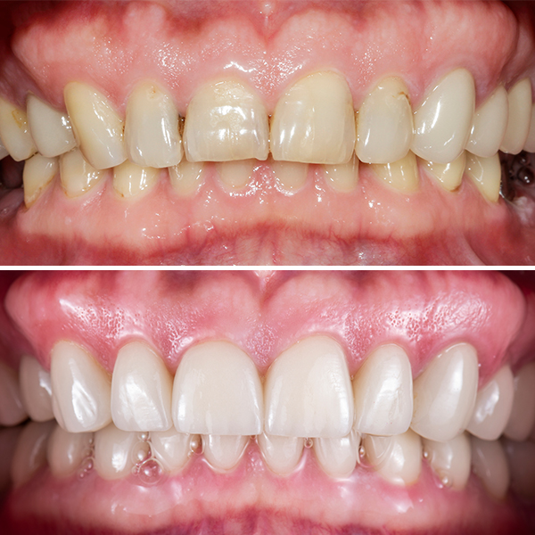 Porcelain Veneers